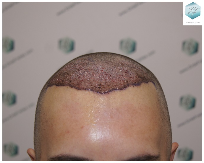 CLINICA DE FREITAS - 2762 GRAFTS FUE 14_zps9v1p1o6u