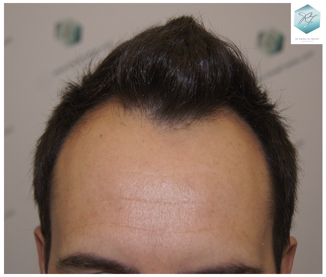 CLINICA DE FREITAS - 2762 GRAFTS FUE 2_zpstclfr4dy