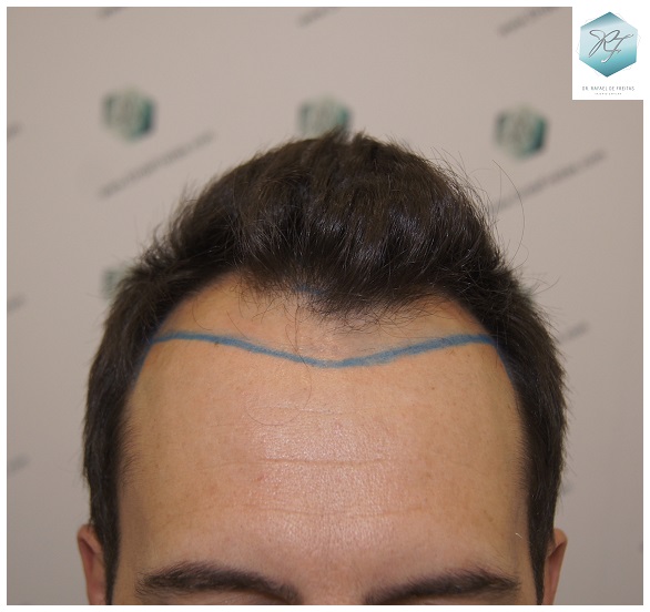 CLINICA DE FREITAS - 2762 GRAFTS FUE 7_zpsuukqqd1y