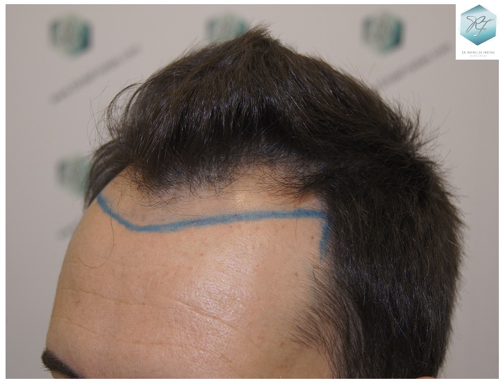 CLINICA DE FREITAS - 2762 GRAFTS FUE 8_zps1o2jznnp