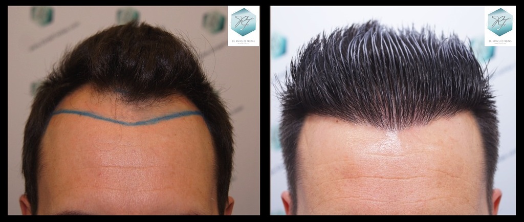 CLINICA DE FREITAS - 2762 GRAFTS FUE Fondo%20negro%204_zpsdo5hrcin