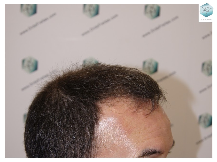 CLINICA DE FREITAS - 2908 GRAFTS FUE 3_zpsfpcdadl2