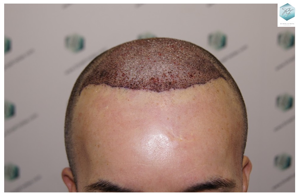 CLINICA DE FREITAS - 2908 GRAFTS FUE 8_zpsdp94t8tm