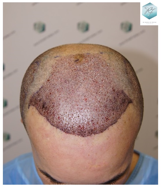 CLINICA DE FREITAS - 2908 GRAFTS FUE 9_zps6xopropx