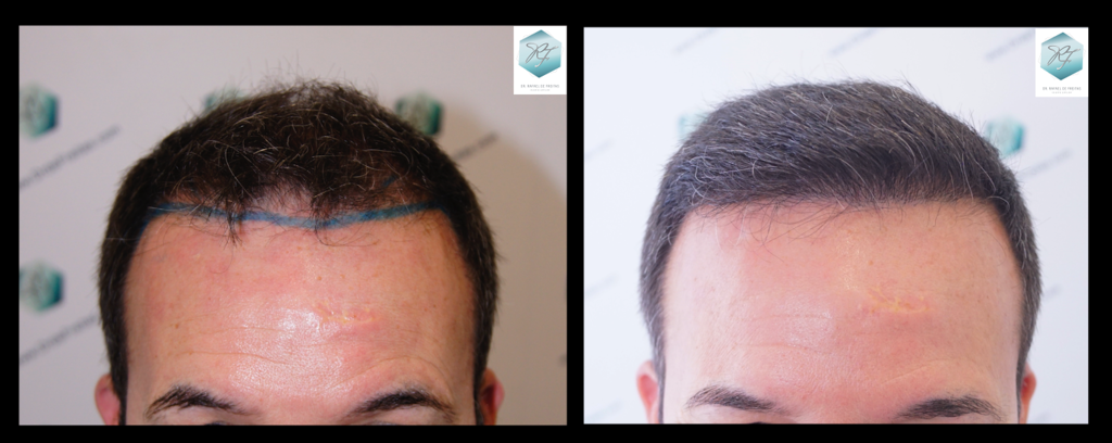 CLINICA DE FREITAS - 2908 GRAFTS FUE Comparativa%201_zpsgmj8r2oz