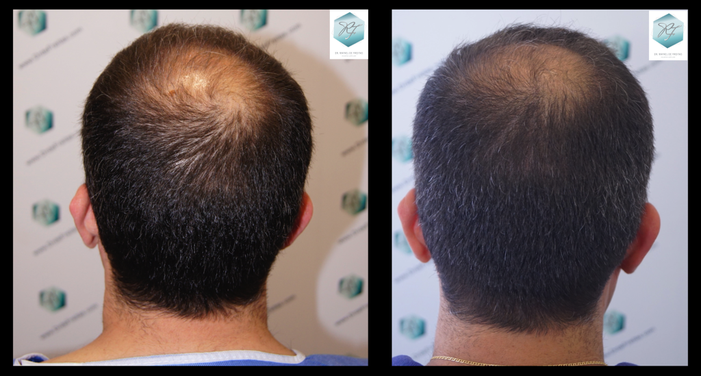 CLINICA DE FREITAS - 2908 GRAFTS FUE Comparativa%203_zps0hylnrpx