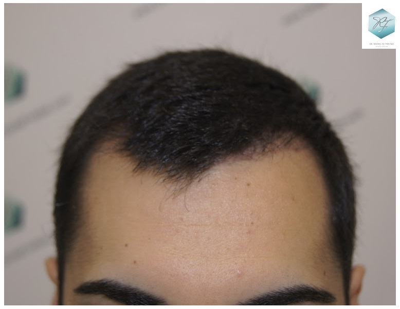 CLINICA DE FREITAS - 3105 GRAFTS FUE 20-EN%203%20MESES_zpsv1yk27bu