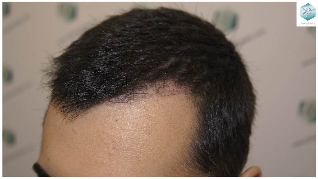 CLINICA DE FREITAS - 3105 GRAFTS FUE 22-EN%203%20MESES_zpsctswozpj