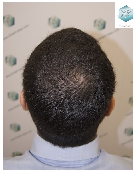 CLINICA DE FREITAS - 3105 GRAFTS FUE 23-EN%203%20MESES_zpsabax2kbc