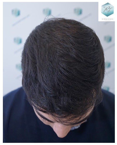 CLINICA DE FREITAS - 3105 GRAFTS FUE 28-EN%209%20MESES_zpsixqjz0v0