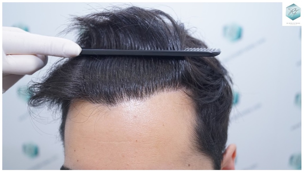 CLINICA DE FREITAS - 3105 GRAFTS FUE 32-EN%201%20ANtildeO._zpspxfyh3kt