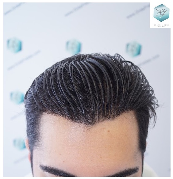 CLINICA DE FREITAS - 3105 GRAFTS FUE 35-EN%201%20ANtildeO._zps4jofkyxc