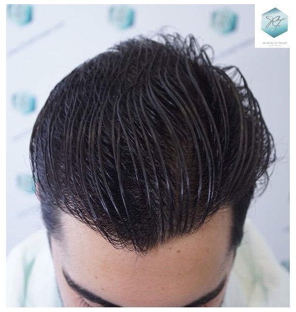 CLINICA DE FREITAS - 3105 GRAFTS FUE 36-EN%201%20ANtildeO._zpswy5vb0mb