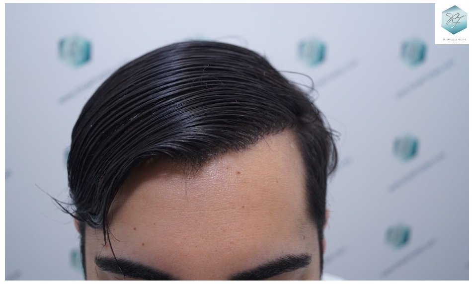 CLINICA DE FREITAS - 3105 GRAFTS FUE 44-EN%201%20ANtildeO._zpso2mls39l