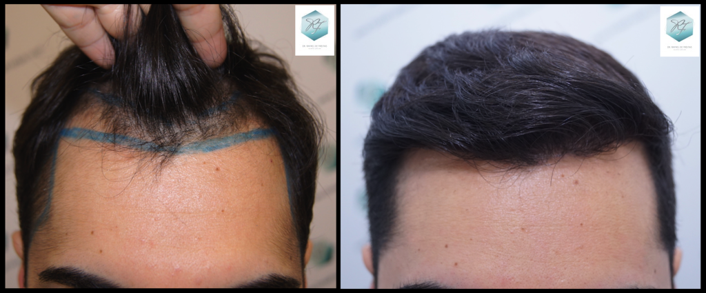 CLINICA DE FREITAS - 3105 GRAFTS FUE Z1-COMPARATIVA_zpsdxkafskl