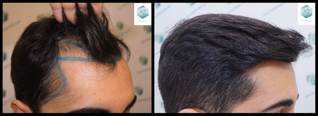 CLINICA DE FREITAS - 3105 GRAFTS FUE Z3-COMPARATIVA_zps0ctz0iyk