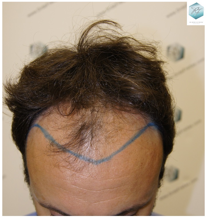 CLINICA DE FREITAS - 3183 GRAFTS FUE 10_zpslqshqbw8