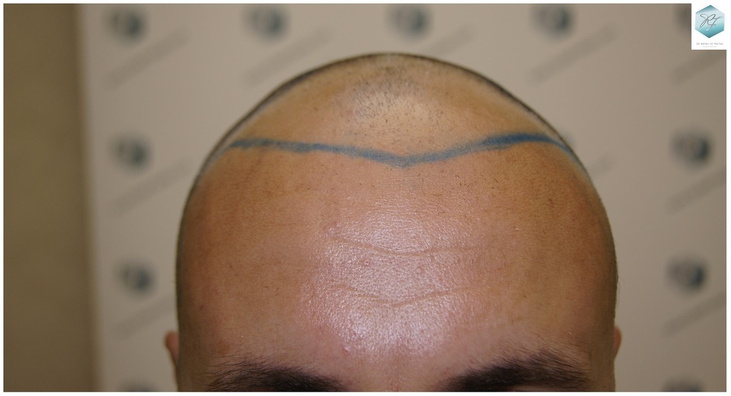 CLINICA DE FREITAS - 3183 GRAFTS FUE 12_zpsieppct9d