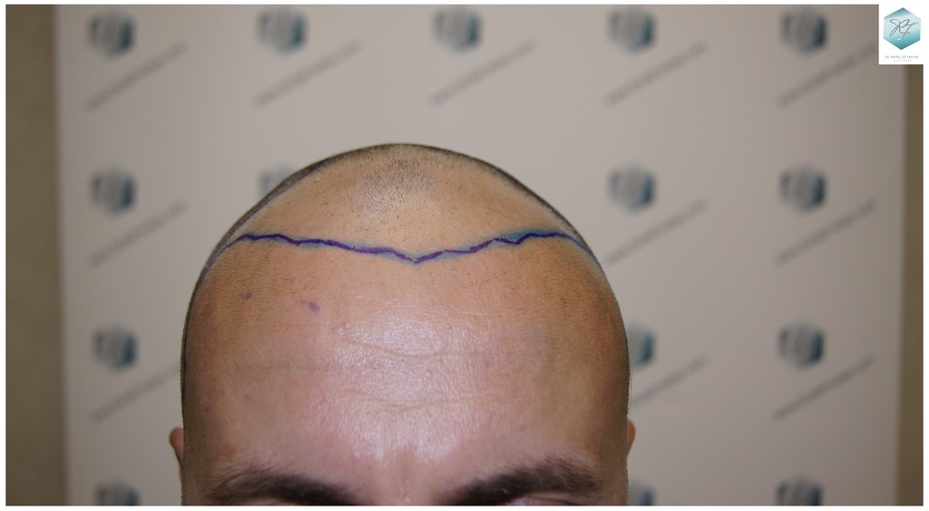 CLINICA DE FREITAS - 3183 GRAFTS FUE 14_zpsegk3p3y5