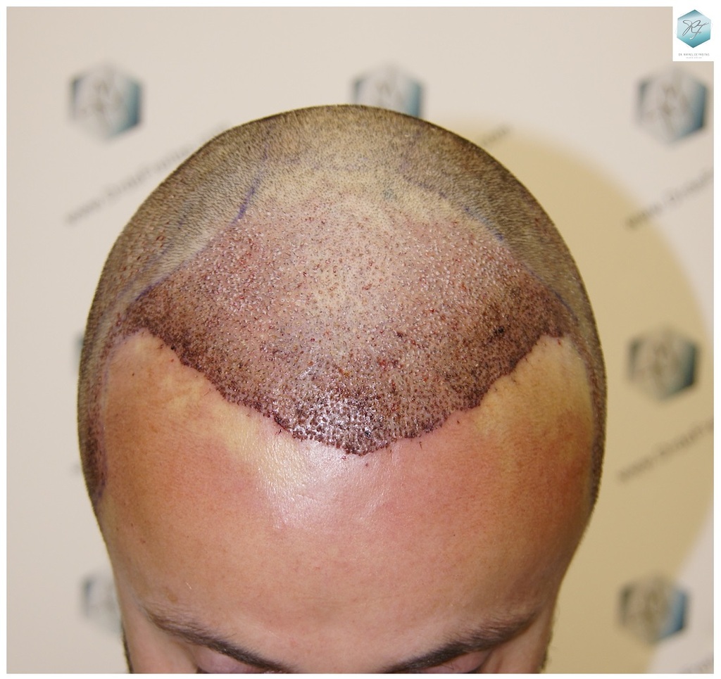 CLINICA DE FREITAS - 3183 GRAFTS FUE 21_zpsrxe8ktui