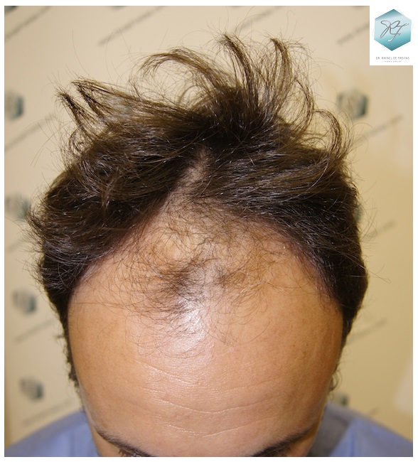 CLINICA DE FREITAS - 3183 GRAFTS FUE 3_zpsdcwksfnl