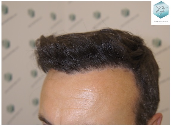 CLINICA DE FREITAS - 3183 GRAFTS FUE 54_zpsqbhd60my