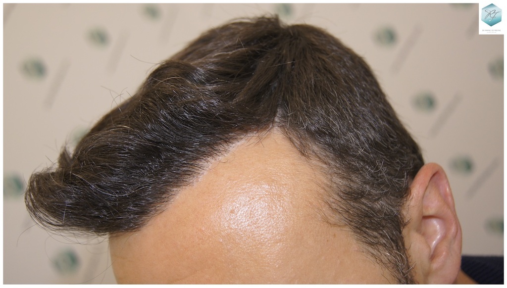 CLINICA DE FREITAS - 3183 GRAFTS FUE 58_zpsfcjsv3dx