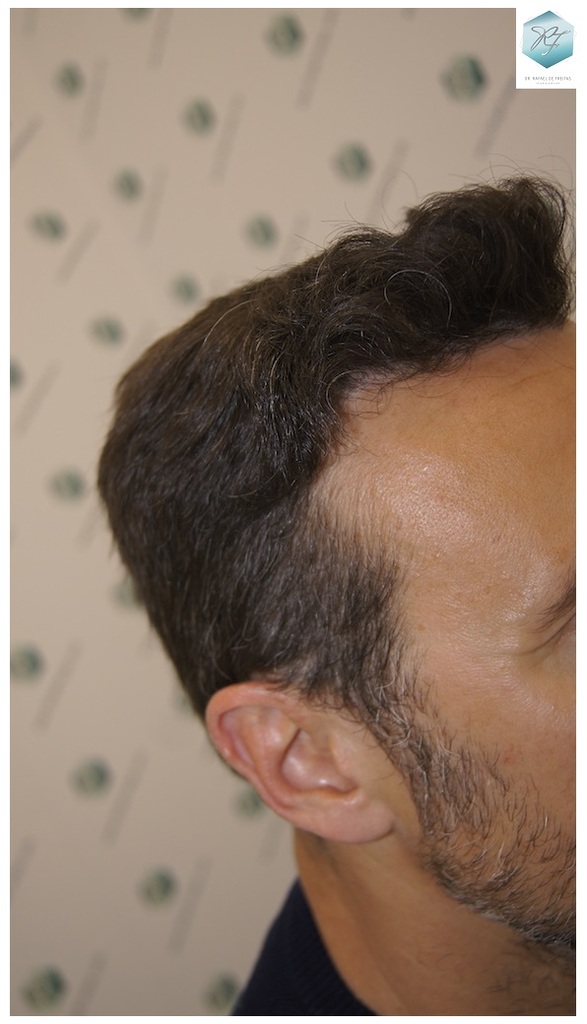 CLINICA DE FREITAS - 3183 GRAFTS FUE 59_zpsuz5y7t4g