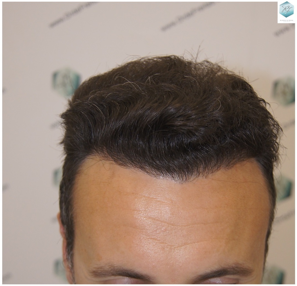 CLINICA DE FREITAS - 3183 GRAFTS FUE 62_zpsy4oylyq7