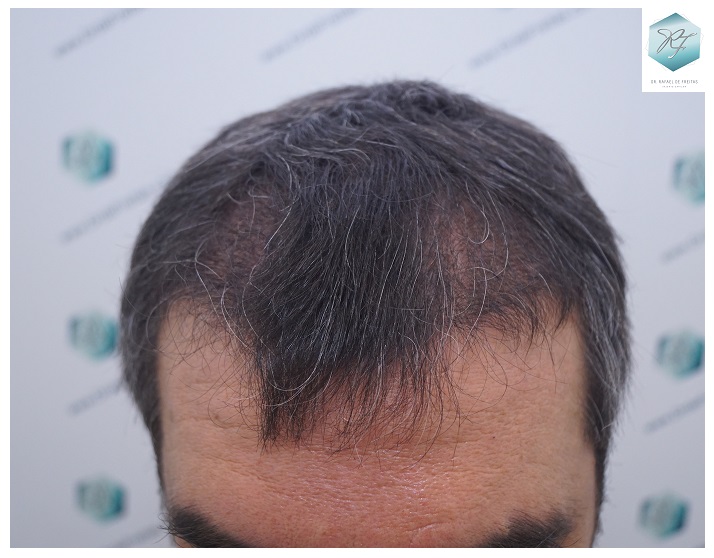 CLINICA DE FREITAS - 3302 GRAFTS FUE 19-EN%203%20MESES_zps00jepoup