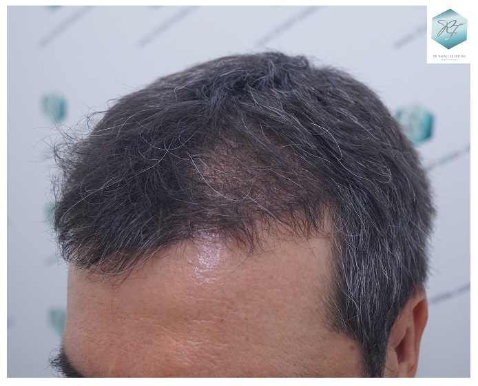 CLINICA DE FREITAS - 3302 GRAFTS FUE 21-EN%203%20MESES_zps1241s2vv