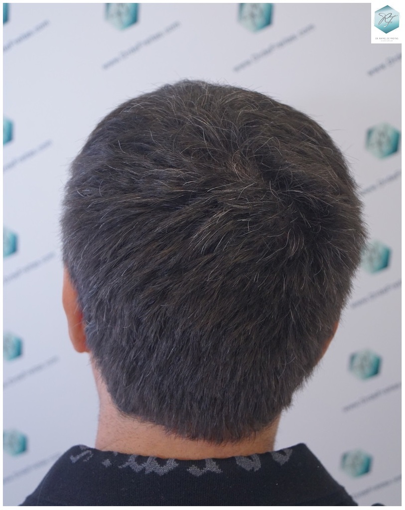 CLINICA DE FREITAS - 3302 GRAFTS FUE 22-EN%203%20MESES_zpsrl3pmyxs