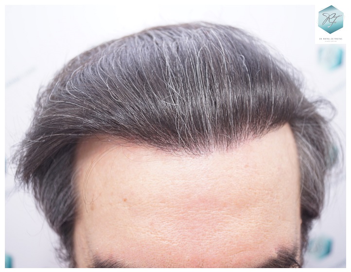 CLINICA DE FREITAS - 3302 GRAFTS FUE 24-EN%201%20ANtildeO_zpstsijlphz