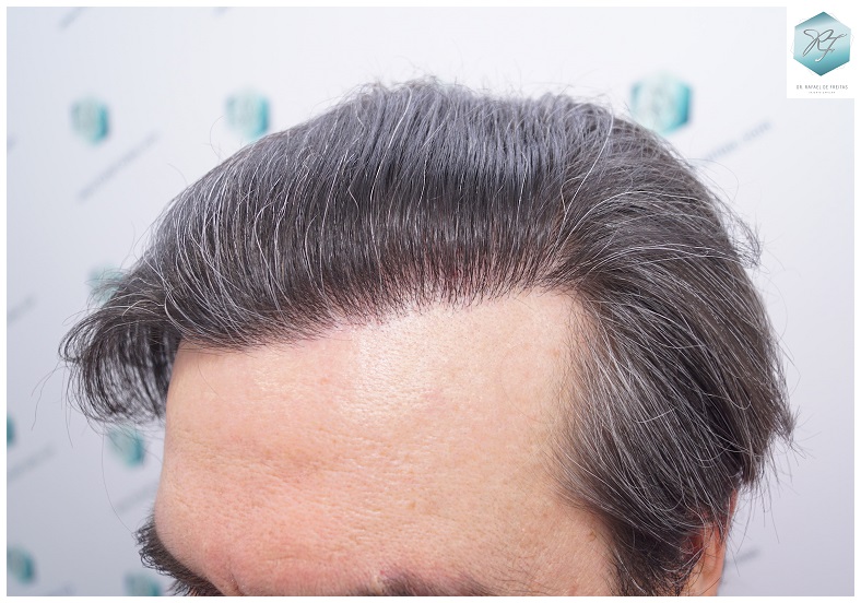 CLINICA DE FREITAS - 3302 GRAFTS FUE 25-EN%201%20ANtildeO_zpszk9dogke