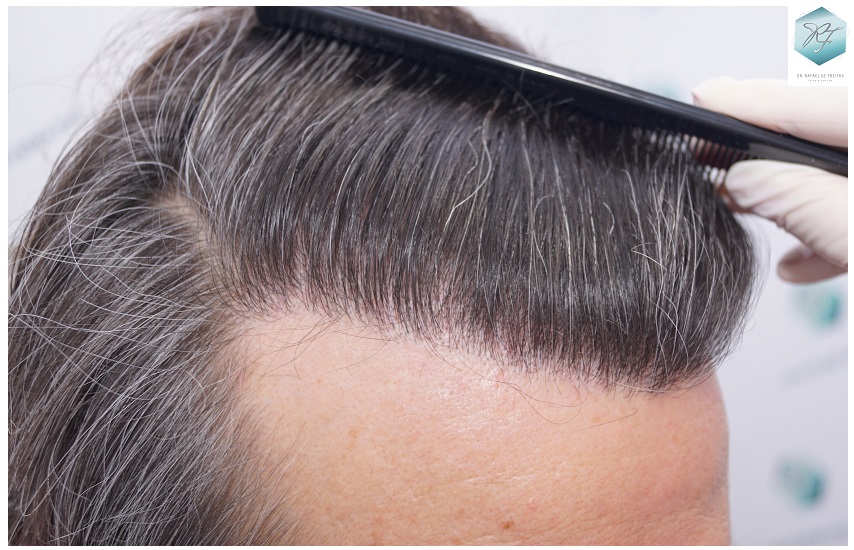 CLINICA DE FREITAS - 3302 GRAFTS FUE 29-EN%201%20ANtildeO_zpsjpyld0ni