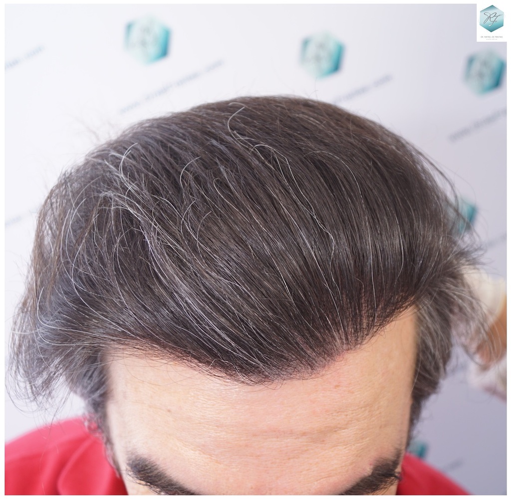 CLINICA DE FREITAS - 3302 GRAFTS FUE 32-EN%201%20ANtildeO_zpsac4bxui9