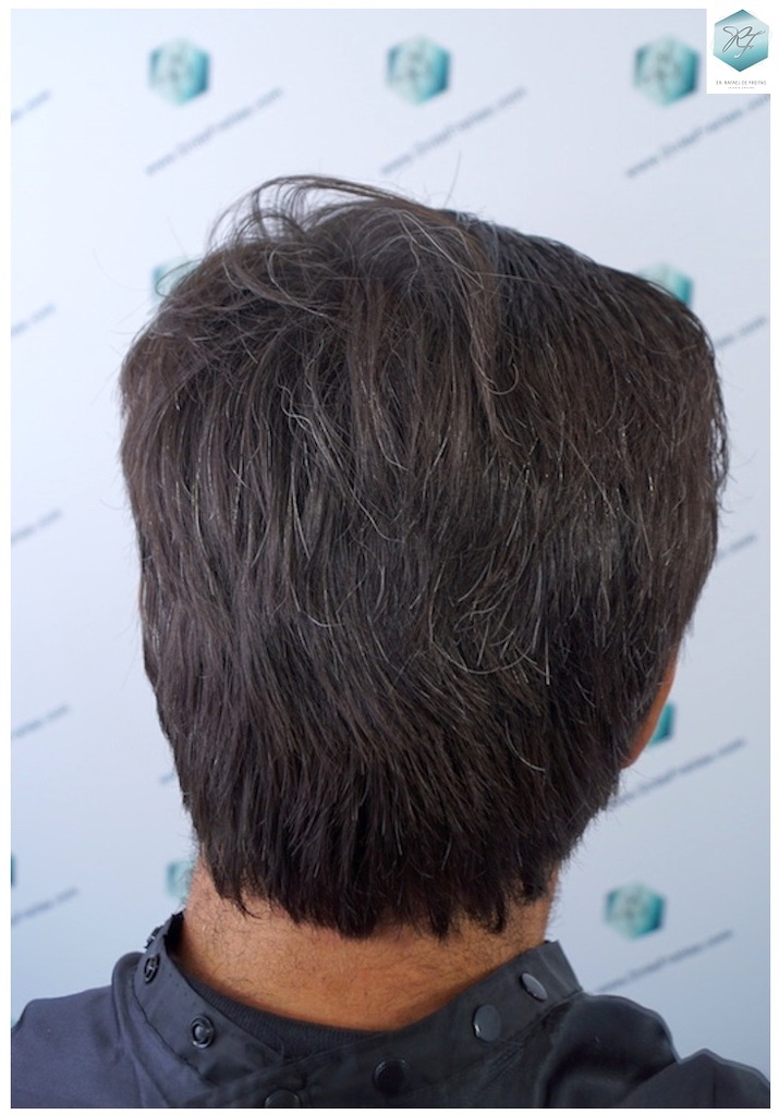 CLINICA DE FREITAS - 3302 GRAFTS FUE 36-EN%201%20ANtildeO_zps2k2rxit7