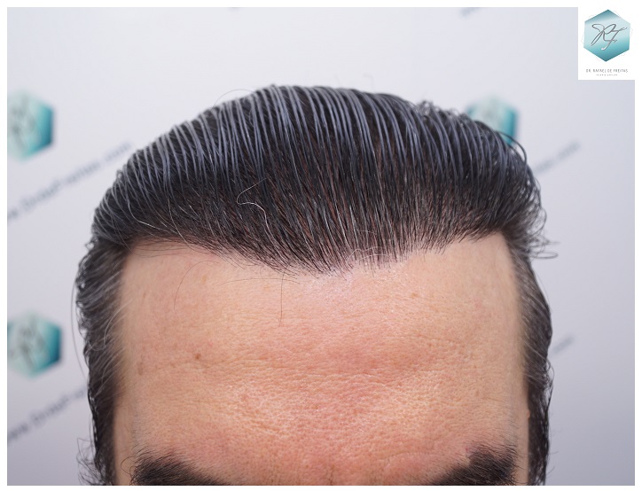 CLINICA DE FREITAS - 3302 GRAFTS FUE 37-EN%201%20ANtildeO_zpsjksscmkc