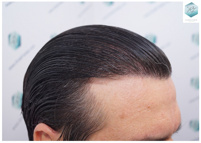 CLINICA DE FREITAS - 3302 GRAFTS FUE 39-EN%201%20ANtildeO_zpsu2c4bk7p