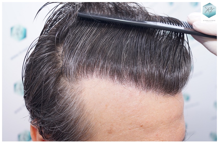 CLINICA DE FREITAS - 3302 GRAFTS FUE 54-EN%201%20ANtildeO_zpsghy1gnmh