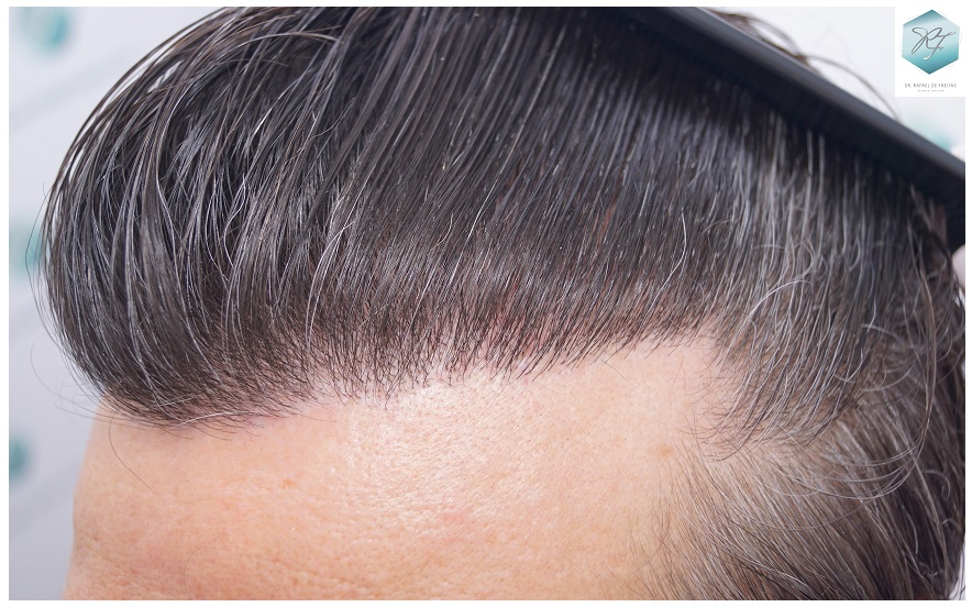 CLINICA DE FREITAS - 3302 GRAFTS FUE 55-EN%201%20ANtildeO_zps196iaggu