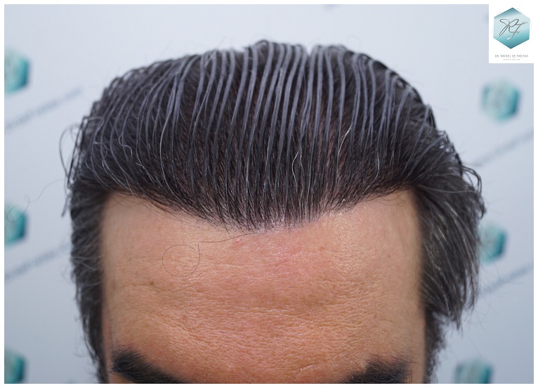 CLINICA DE FREITAS - 3302 GRAFTS FUE 58-EN%201%20ANtildeO_zpsn1ua7xxe