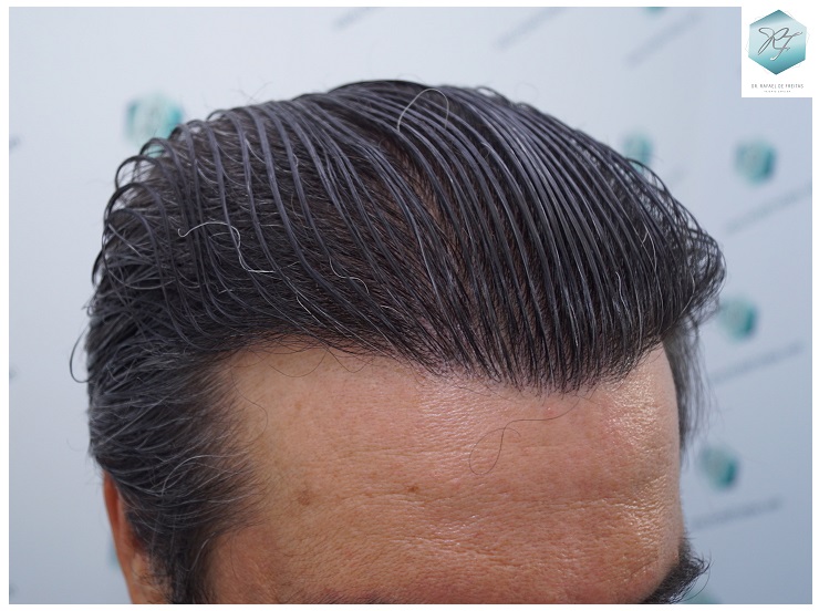 CLINICA DE FREITAS - 3302 GRAFTS FUE 59-EN%201%20ANtildeO_zps5dwxyh7y