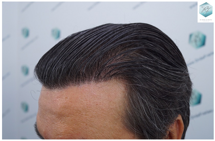 CLINICA DE FREITAS - 3302 GRAFTS FUE 61-EN%201%20ANtildeO_zpsvhm7wcvu