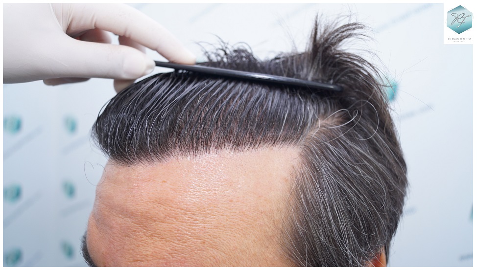 CLINICA DE FREITAS - 3302 GRAFTS FUE 63-EN%201%20ANtildeO_zpsptbyalvi