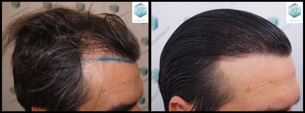 CLINICA DE FREITAS - 3302 GRAFTS FUE Fondo%20negro%205_zpsyxnh7mjy