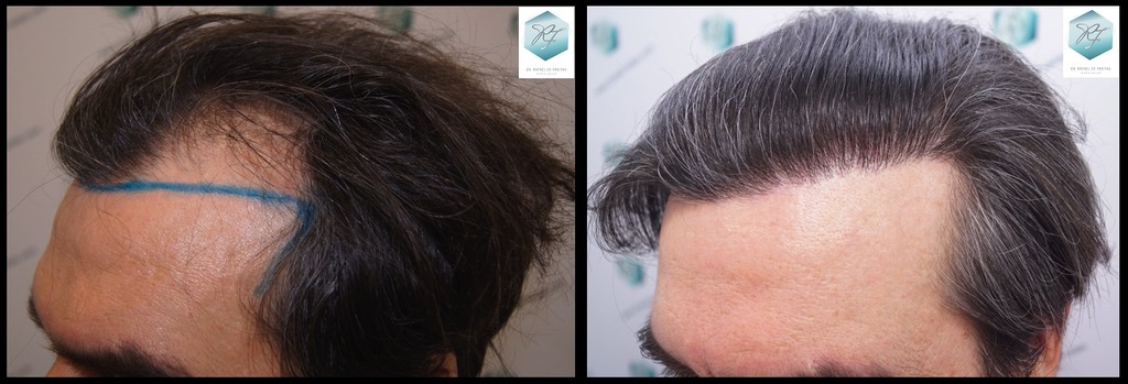 CLINICA DE FREITAS - 3302 GRAFTS FUE Fondo%20negro%207_zpsaxy9lwgb