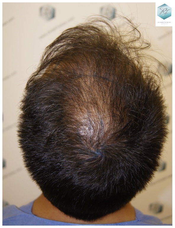 CLINICA DE FREITAS - 3401 + 2829 GRAFTS FUE (TOT, 6230 FUE) 10_zpsmqws2toe