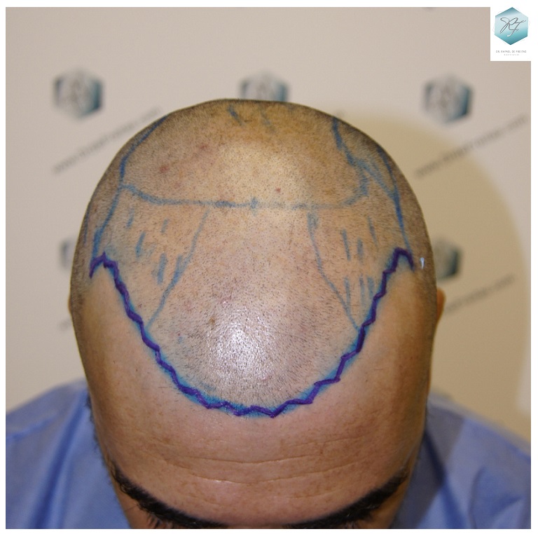 CLINICA DE FREITAS - 3401 + 2829 GRAFTS FUE (TOT, 6230 FUE) 13_zpsdagzmdh0