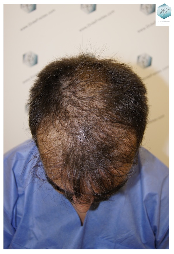 CLINICA DE FREITAS - 3401 + 2829 GRAFTS FUE (TOT, 6230 FUE) 1_zpsvt18khst